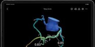 Heartflow Targets $180M IPO to Expand 3D Heart Imaging Software Heartflow IPO